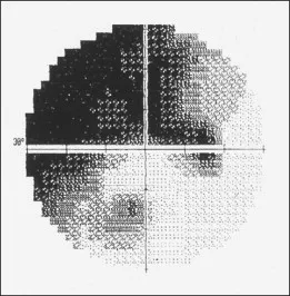 Before treatment vision test