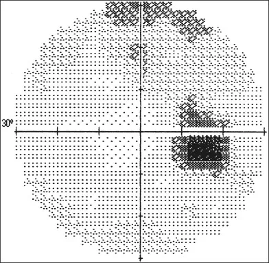 After treatment vision test